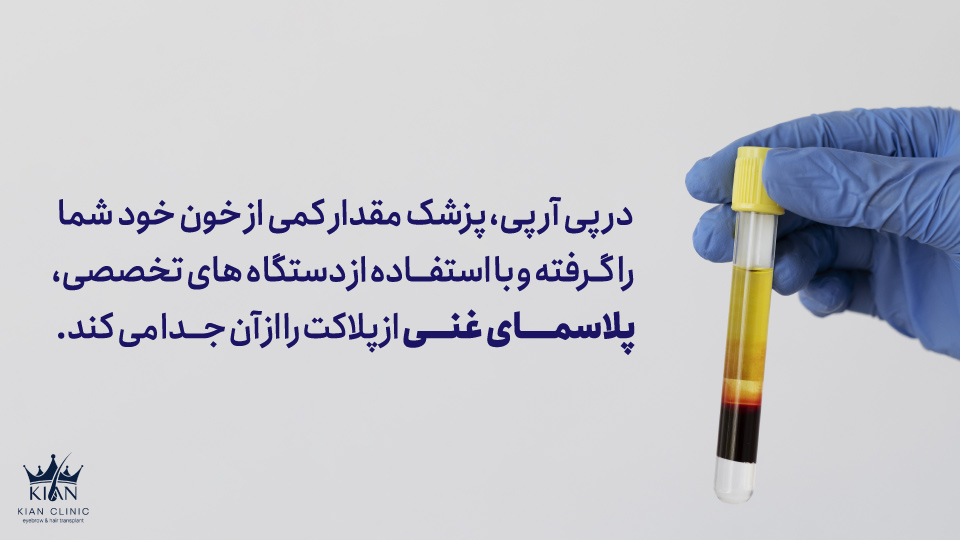 در پی ار پی، پزشک مقدار کمی از خون خود شما را گرفته و با استفاده از دستگاه های تخصصی، پلاسمای غنی از پلاکت را از آن جدا می کند.