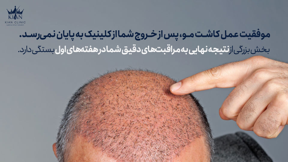 موفقیت عمل کاشت مو، پس از خروج شما از کلینیک به پایان نمیرسد. بخش بزرگی از نتیجه نهایی به مراقبتهای دقیق شما در هفتههای اول بستگی دارد.