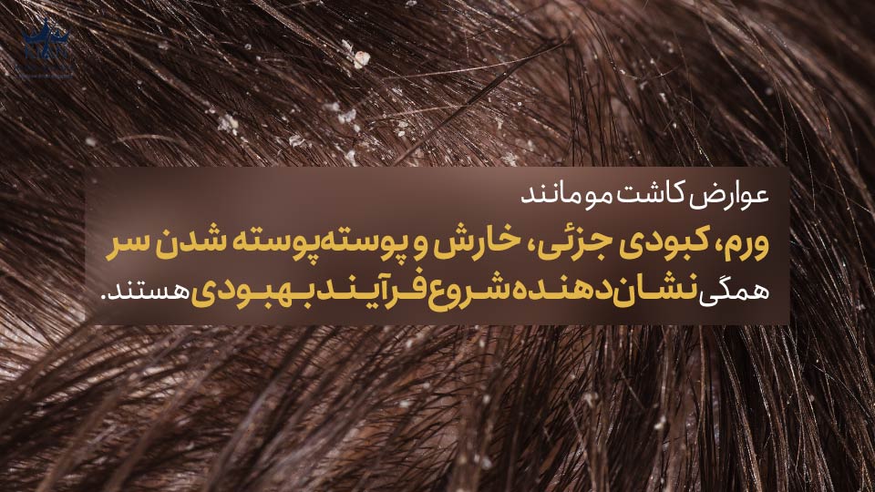 عوارض کاشت مو مانند ورم، کبودی جزئی، خارش و پوستهپوسته شدن سر همگی نشاندهنده شروع فرآیند بهبودی هستند.