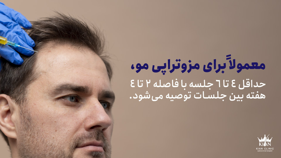 معمولاً برای مزوتراپی مو، حداقل ۴ تا ۶ جلسه با فاصله ۲ تا ۴ هفته بین جلسات توصیه میشود.