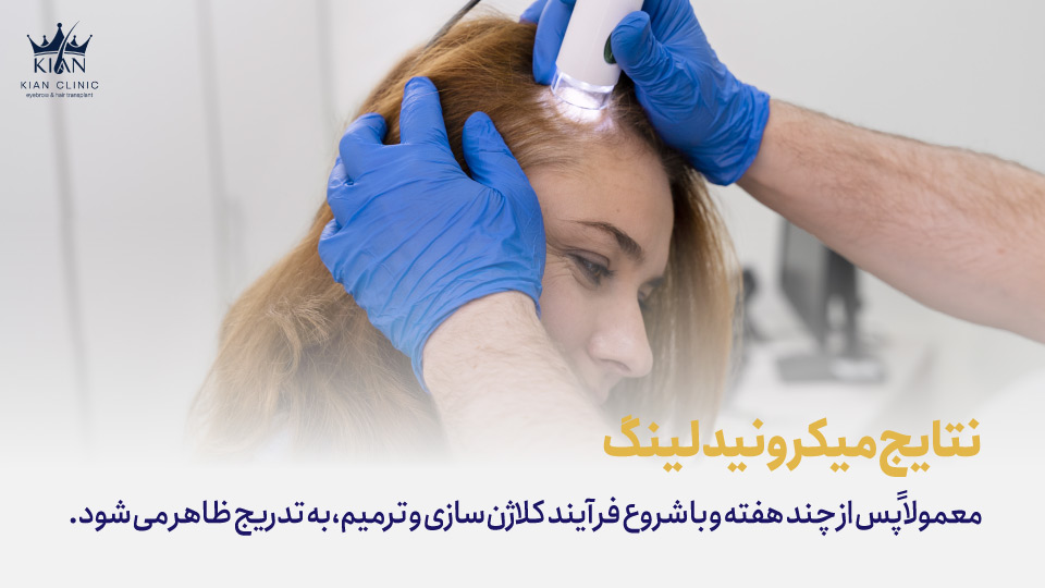 نتایج میکرونیدلینگ معمولاً پس از چند هفته و با شروع فرآیند کلاژنسازی و ترمیم، به تدریج ظاهر میشود.