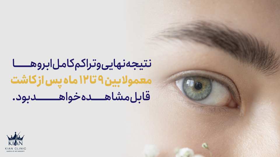 نتیجه نهایی و تراکم کامل ابروها معمولا بین ۹ تا ۱۲ ماه پس از کاشت قابل مشاهده خواهد بود.