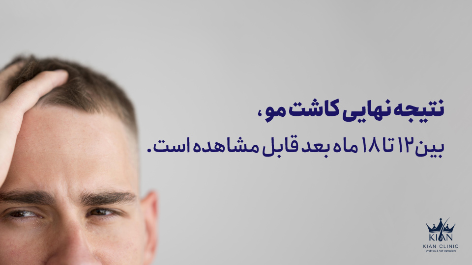 نتیجه نهایی کاشت مو بین ۱۲ تا ۱۸ ماه بعد قابل مشاهده است.