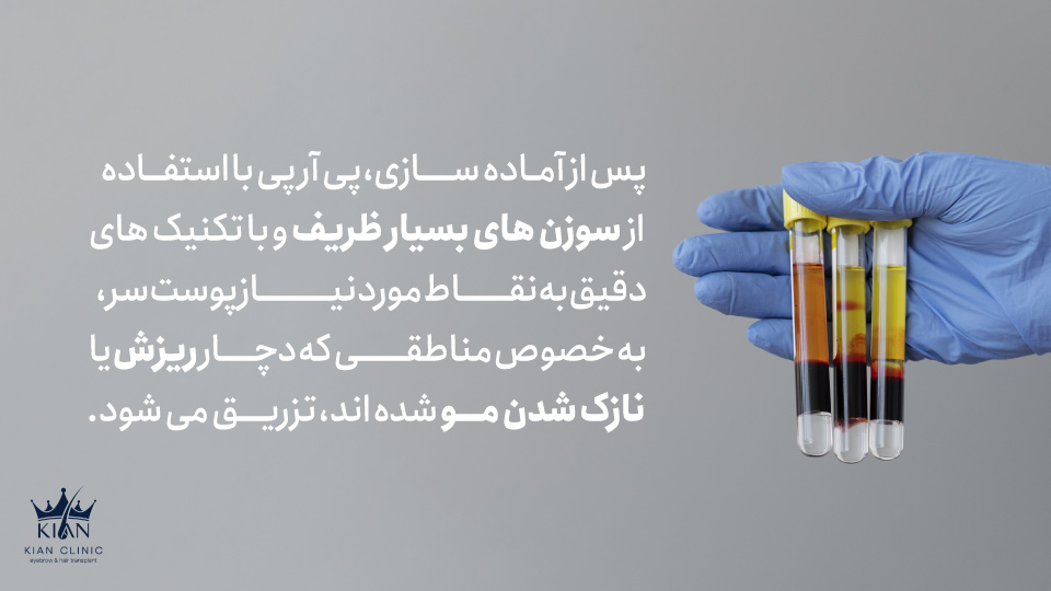 پس از آماده سازی، پی آر پی با استفاده از سوزن های بسیار ظریف و با تکنیک های دقیق به نقاط مورد نیاز پوست سر، به خصوص مناطقی که دچار ریزش یا نازک شدن مو شده اند، تزریق می شود.