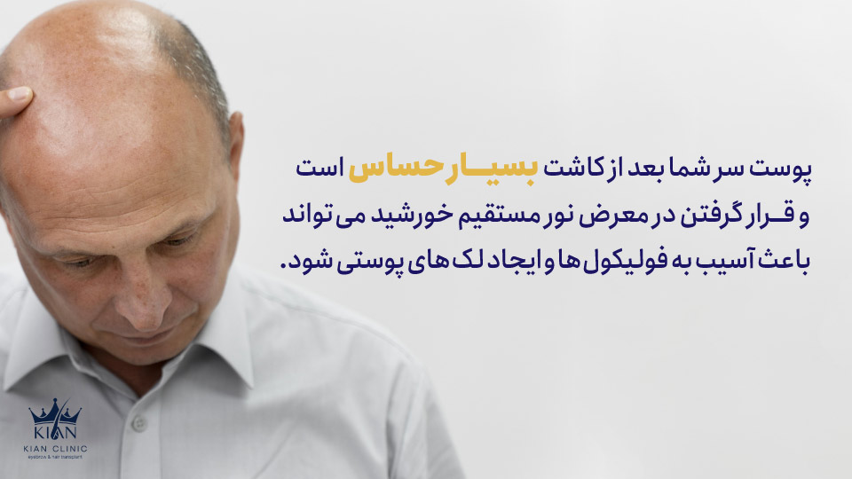 پوست سر شما بعد از کاشت بسیار حساس است و قرار گرفتن در معرض نور مستقیم خورشید میتواند باعث آسیب به فولیکولها و ایجاد لکهای پوستی شود.