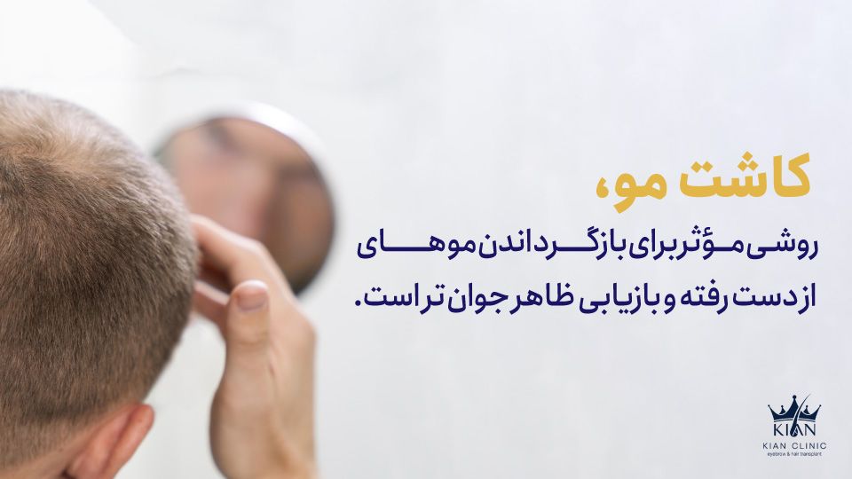 کاشت مو روشی مؤثر برای بازگرداندن موهای از دست رفته و بازیابی ظاهر جوانتر است.
