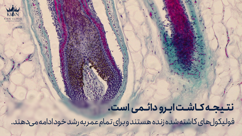 نتیجه کاشت ابرو دائمی است. فولیکولهای کاشته شده زنده هستند و برای تمام عمر به رشد خود ادامه میدهند.