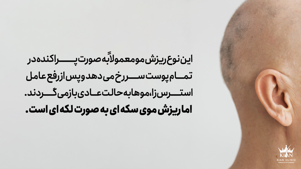 این نوع ریزش مو معمولاً به صورت پراکنده در تمام پوست سر رخ می دهد و پس از رفع عامل استرس زا، موها به حالت عادی بازمی گردند. اما ریزش موی سکه ای به صورت لکه ای است.
