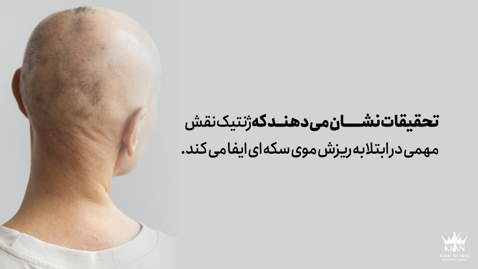 تحقیقات نشان می دهند که ژنتیک نقش مهمی در ابتلا به ریزش موی سکه ای ایفا می کند.