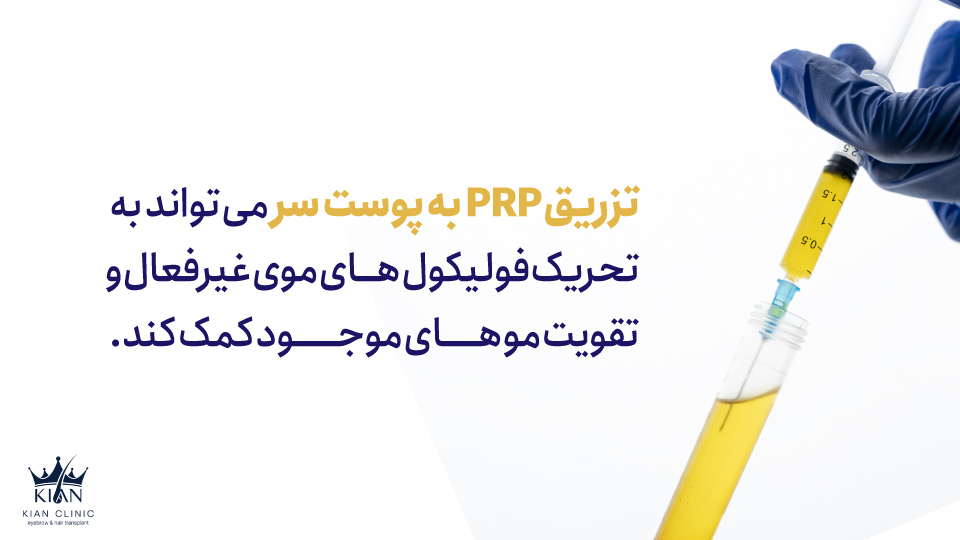 تزریق PRP به پوست سر میتواند به تحریک فولیکولهای موی غیرفعال و تقویت موهای موجود کمک کند.