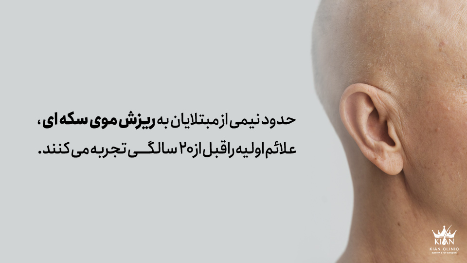 حدود نیمی از مبتلایان به ریزش موی سکه ای ، علائم اولیه را قبل از ۲۰ سالگی تجربه می کنند.