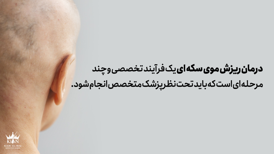 درمان ریزش موی سکه ای یک فرآیند تخصصی و چندمرحله ای است که باید تحت نظر پزشک متخصص انجام شود.