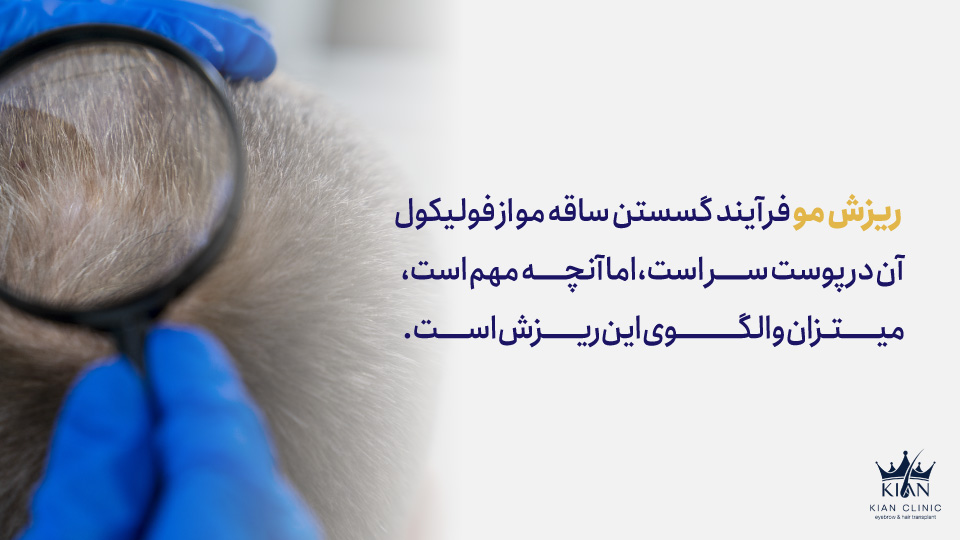 ریزش مو فرآیند گسستن ساقه مو از فولیکول آن در پوست سر است، اما آنچه مهم است، میزان و الگوی این ریزش است.