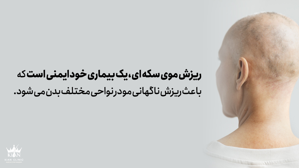 ریزش موی سکه ای، یک بیماری خودایمنی است که باعث ریزش ناگهانی مو در نواحی مختلف بدن می شود.