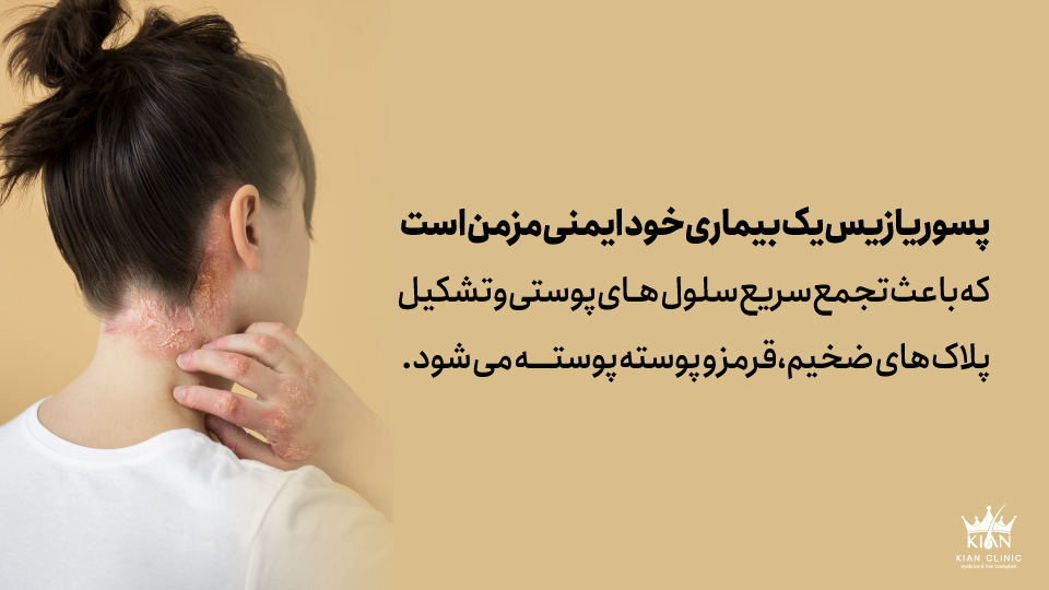 پسوریازیس یک بیماری خودایمنی مزمن است که باعث تجمع سریع سلولهای پوستی و تشکیل پلاکهای ضخیم، قرمز و پوستهپوسته میشود.