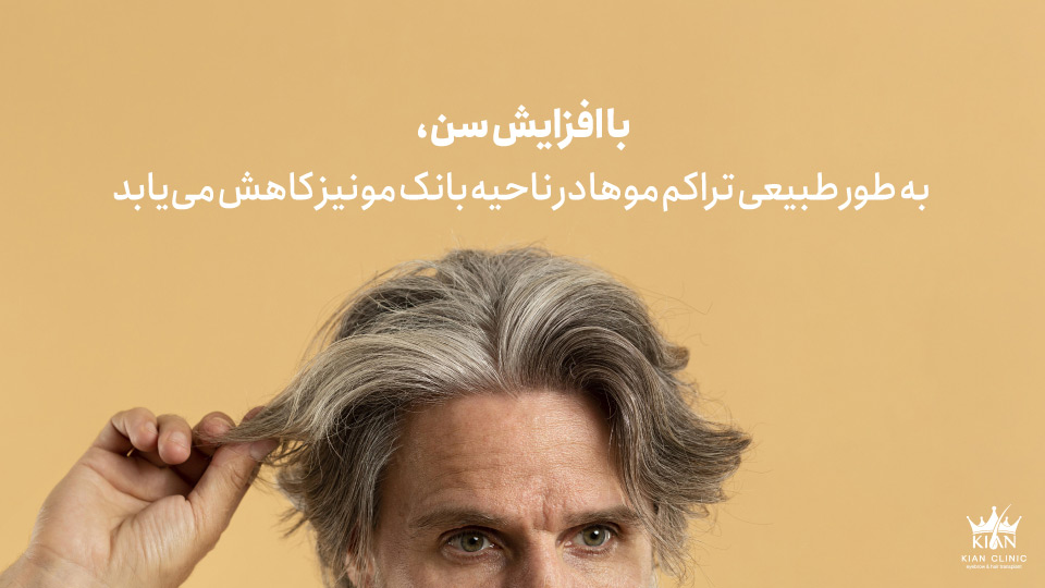 با افزایش سن، به طور طبیعی تراکم موها در ناحیه بانک مو نیز کاهش مییابد
