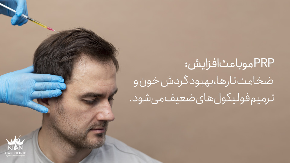 PRPموباعث افزایش ضخامت تارها، بهبود گردش خون و ترمیم فولیکولهای ضعیف میشود.