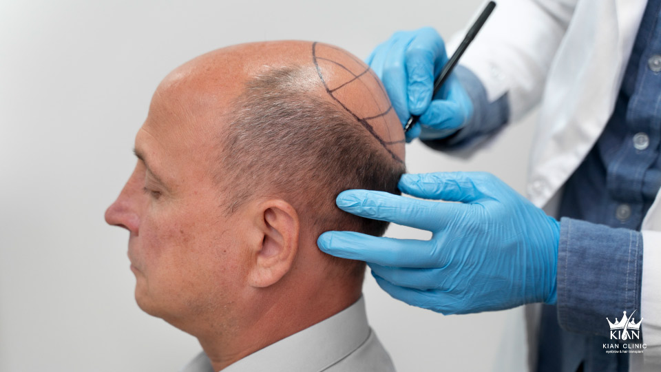 عادت های ناسالم مثل مصرف دخانیات، کمخوابی و استرس مزمن می توانند جریان خون را کاهش داده و روند ترمیم پوست را مختل کنند.
